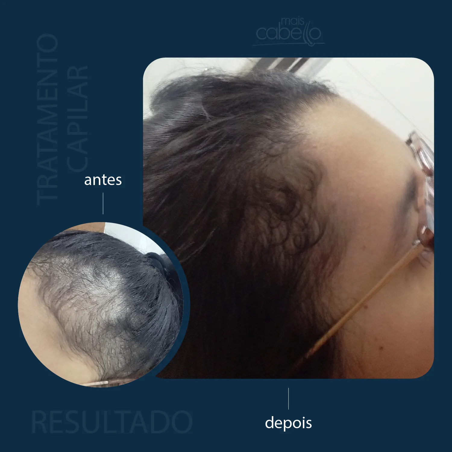 Antes e depois com preenchimento frontal capilar